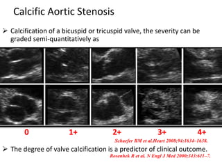 Calcific Aortic Stenosis
 Calcification of a bicuspid or tricuspid valve, the severity can be
graded semi-quantitatively as
0 1+ 2+ 3+ 4+
Schaefer BM et al.Heart 2008;94:1634–1638.
 The degree of valve calcification is a predictor of clinical outcome.
Rosenhek R et al. N Engl J Med 2000;343:611–7.
 