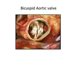 Bicuspid Aortic valve
 