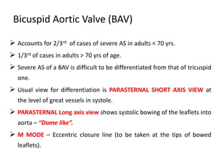 Bicuspid Aortic Valve (BAV)
 Accounts for 2/3rd of cases of severe AS in adults < 70 yrs.
 1/3rd of cases in adults > 70 yrs of age.
 Severe AS of a BAV is difficult to be differentiated from that of tricuspid
one.
 Usual view for differentiation is PARASTERNAL SHORT AXIS VIEW at
the level of great vessels in systole.
 PARASTERNAL Long axis view shows systolic bowing of the leaflets into
aorta – “Dome like”.
 M MODE – Eccentric closure line (to be taken at the tips of bowed
leaflets).
 