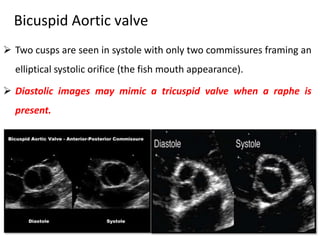 Bicuspid Aortic valve
 Two cusps are seen in systole with only two commissures framing an
elliptical systolic orifice (the fish mouth appearance).
 Diastolic images may mimic a tricuspid valve when a raphe is
present.
 