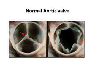 Normal Aortic valve
 