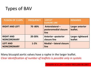 Types of BAV
FUSION OF CUSPS FREQUENCY LEAFLET
CLOSURE LINE
REMARKS
RIGHT AND LEFT 70 -80% Anterolateral –
posteromedial closure
line
Larger anterior
leaflet.
RIGHT AND
NONCORONARY
20-30% Anterior –posterior
closure line
Larger rightward
leaflet
LEFT AND
NONCORONARY
1-2% Medial – lateral closure
line
Many bicuspid aortic valves have a raphe in the larger leaflet.
Clear identification of number of leaflets is possible only in systole.
Schaefer et al ,Am J Cardiol 99(5);686-90.2007
 