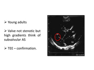  Young adults
 Valve not stenotic but
high gradients think of
subvalvular AS
 TEE – confirmation.
 