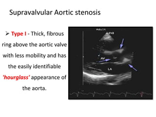 Supravalvular Aortic stenosis
 Type I - Thick, fibrous
ring above the aortic valve
with less mobility and has
the easily identifiable
'hourglass' appearance of
the aorta.
 