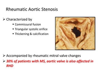 Rheumatic Aortic Stenosis
 Characterized by
 Commissural fusion
 Triangular systolic orifice
 Thickening & calcification
 Accompanied by rheumatic mitral valve changes
 30% of patients with MS, aortic valve is also affected in
RHD
 