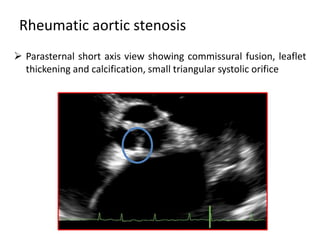 Rheumatic aortic stenosis
 Parasternal short axis view showing commissural fusion, leaflet
thickening and calcification, small triangular systolic orifice
 