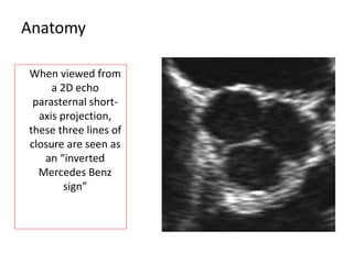 Anatomy
When viewed from
a 2D echo
parasternal short-
axis projection,
these three lines of
closure are seen as
an “inverted
Mercedes Benz
sign”
 