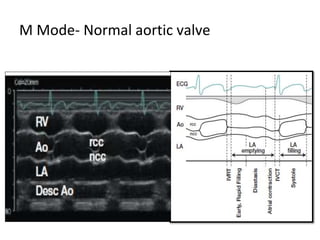 M Mode- Normal aortic valve
 