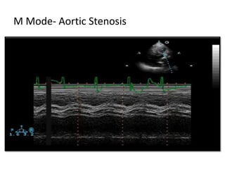 M Mode- Aortic Stenosis
 