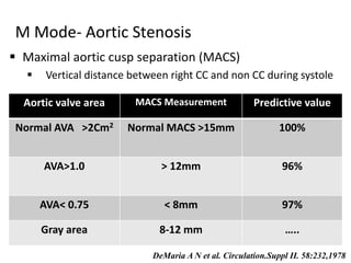  Maximal aortic cusp separation (MACS)
 Vertical distance between right CC and non CC during systole
M Mode- Aortic Stenosis
Aortic valve area MACS Measurement Predictive value
Normal AVA >2Cm2 Normal MACS >15mm 100%
AVA>1.0 > 12mm 96%
AVA< 0.75 < 8mm 97%
Gray area 8-12 mm …..
DeMaria A N et al. Circulation.Suppl II. 58:232,1978
 