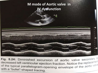M mode of Aortic valve in
LV dysfunction
 