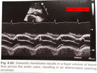 Sub aortic membrane
 