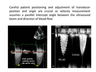 Careful patient positioning and adjustment of transducer
position and angle are crucial as velocity measurement
assumes a parallel intercept angle between the ultrasound
beam and direction of blood flow
 