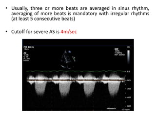 • Usually, three or more beats are averaged in sinus rhythm,
averaging of more beats is mandatory with irregular rhythms
(at least 5 consecutive beats)
• Cutoff for severe AS is 4m/sec
 