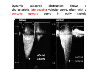 Dynamic subaortic obstruction shows a
characteristic late-peaking velocity curve, often with a
concave upward curve in early systole
 