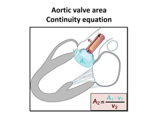 Aortic valve area
Continuity equation
 