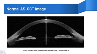 Normal AS-OCT Image
14
Picture courtesy: https://www.opsweb.org/page/ASOCT; Su-Ho Lim et al.
 