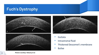 Fuch’s Dystrophy
▸ Guttata
▸ Intrastromal ﬂuid
▸ Thickened Descemet’s membrane
▸ Bullae
20 Picture courtesy: Kaluzny et al.
 
