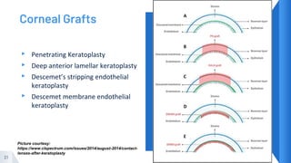 Corneal Grafts
▸ Penetrating Keratoplasty
▸ Deep anterior lamellar keratoplasty
▸ Descemet’s stripping endothelial
keratoplasty
▸ Descemet membrane endothelial
keratoplasty
21
Picture courtesy:
https://www.clspectrum.com/issues/2014/august-2014/contact-
lenses-after-keratoplasty
 