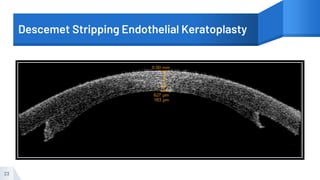 Descemet Stripping Endothelial Keratoplasty
23
 