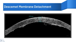 Descemet Membrane Detachment
24
 