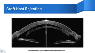 Graft Host Rejection
25
Picture courtesy: https://www.optometricmanagement.com
 