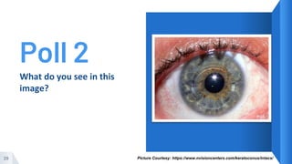 Poll 2
29
What do you see in this
image?
Picture Courtesy: https://www.nvisioncenters.com/keratoconus/intacs/
 