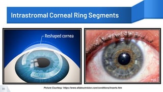Intrastromal Corneal Ring Segments
30 Picture Courtesy: https://www.allaboutvision.com/conditions/inserts.htm
 