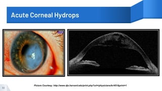 Acute Corneal Hydrops
32
Picture Courtesy: http://www.djo.harvard.edu/print.php?url=/physicians/kr/451&print=1
 