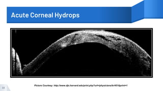 Acute Corneal Hydrops
33
Picture Courtesy: http://www.djo.harvard.edu/print.php?url=/physicians/kr/451&print=1
 