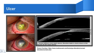 Ulcer
34
Picture Courtesy: https://www.msdmanuals.com/home/eye-disorders/corneal-
disorders/corneal-ulcer
 