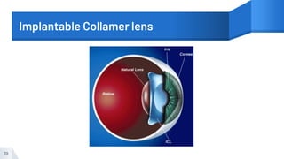 Implantable Collamer lens
39
 