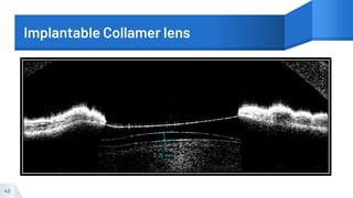Implantable Collamer lens
40
 