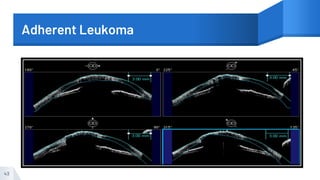 Adherent Leukoma
43
 