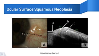 Ocular Surface Squamous Neoplasia
44
Picture Courtesy: Nanji et al
 
