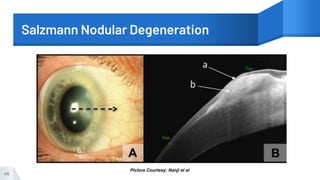 Salzmann Nodular Degeneration
45
Picture Courtesy: Nanji et al
 