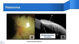 Melanoma
48
Shadowing below
the lesion
Picture Courtesy: Nanji et al
 