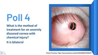 Poll 4
50
What is the method of
treatment for an severely
diseased cornea with
chemical injury?
It is bilateral
Picture Courtesy: https://www.pinterest.com/pin/542543086337849476/
 
