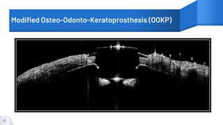 Modified Osteo-Odonto-Keratoprosthesis (OOKP)
51
 