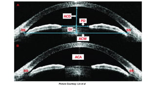 Picture Courtesy: Lin et al
AS-OCT by Swetha Ravichandran
 