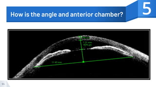 54
How is the angle and anterior chamber? 5
 