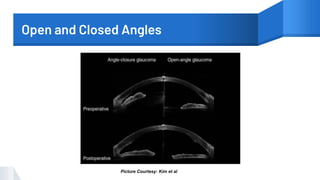 Open and Closed Angles
Picture Courtesy: Kim et al
 