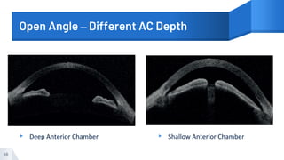 Open Angle – Different AC Depth
▸ Deep Anterior Chamber ▸ Shallow Anterior Chamber
56
 
