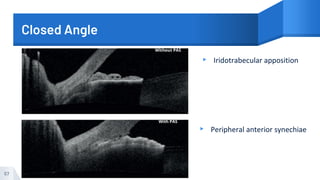 Closed Angle
▸ Iridotrabecular apposition
▸ Peripheral anterior synechiae
57
 