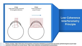 “ Low-Coherence
Interferometry
Principle
Picture courtesy: https://www.leica-microsystems.com/science-lab/what-is-oct-and-how-can-it-help-ophthalmologists-acquire-high-
resolution-information-on-ocular-tissue/; https://www.slideshare.net/sealdioftal/oct-presentation
 