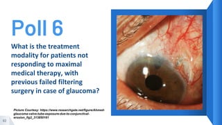 Poll 6
62
What is the treatment
modality for patients not
responding to maximal
medical therapy, with
previous failed filtering
surgery in case of glaucoma?
Picture Courtesy: https://www.researchgate.net/figure/Ahmed-
glaucoma-valve-tube-exposure-due-to-conjunctival-
erosion_fig2_313850161
 