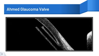 Ahmed Glaucoma Valve
63
 