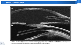 64
Ahmed Glaucoma Valve
Picture Courtesy: https://www.semanticscholar.org/paper/Coupling-of-HRT-II-and-AS-OCT-to-evaluate-corneal-
Mendrinos-Dosso/ac95d75c3de7aef883906b8c9bd2188a1078f768/figure/0
 