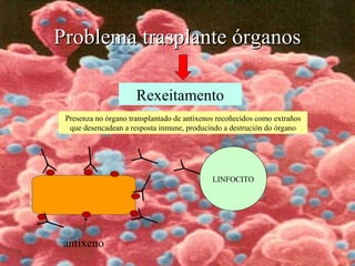 Problema trasplante órganosProblema trasplante órganos
Rexeitamento
Presenza no órgano transplantado de antíxenos recoñecidos como extraños
que desencadean a resposta inmune, producindo a destrución do órgano
antíxeno
LINFOCITO
 