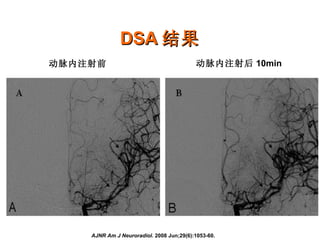 DSA 结果 动脉内注射前 动脉内注射后 10min AJNR Am J Neuroradiol.  2008 Jun;29(6):1053-60.  